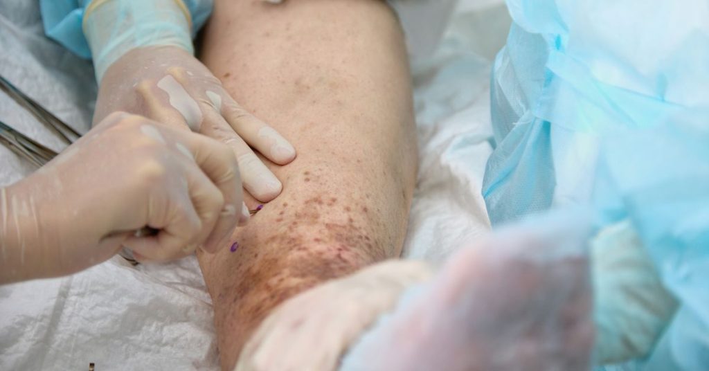 Why Does a Leg Wound Need a Vascular Surgeon