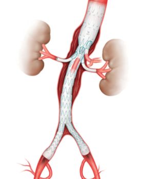 Endovascular Abdominal Aortic Aneurysm Repair (EVAR) (2)