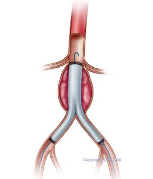 Endovascular Abdominal Aortic Aneurysm Repair (EVAR) (3)