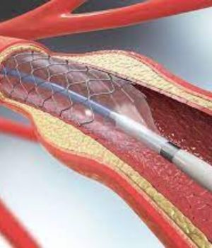 Percutaneous Transcarotid Artery Revascularization (TCAR) (2)