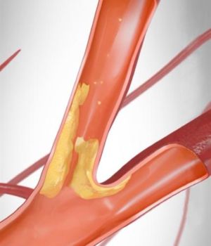 Percutaneous Transcarotid Artery Revascularization (TCAR) (3)