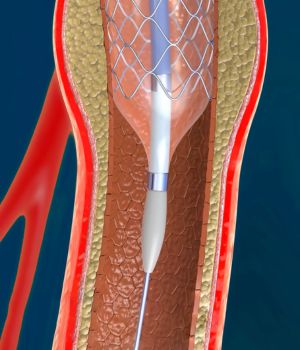 Percutaneous Transcarotid Artery Revascularization (TCAR)
