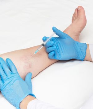Sclerotherapy