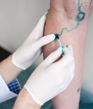 Sclerotherapy For Vein Treatment