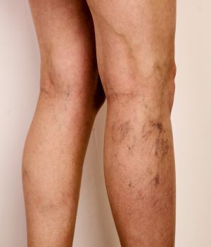 Varicose Vein Treatment