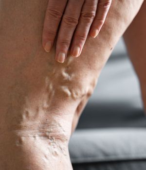 Varicose Vein Treatment (3)