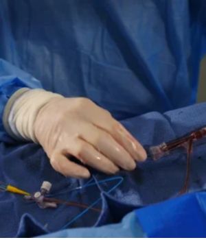 embolization procedure