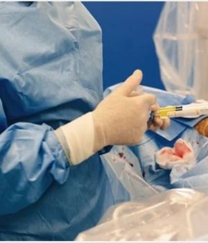 embolization procedure