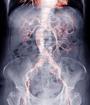 Aortic, Peripheral, and Visceral Aneurysm (3)