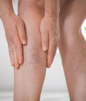Deep Vein Thrombosis (DVT) (3)