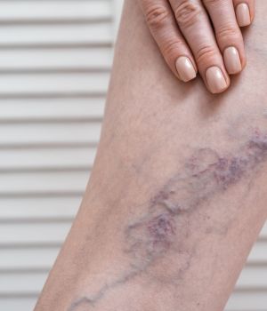 Deep Vein Thrombosis (DVT)