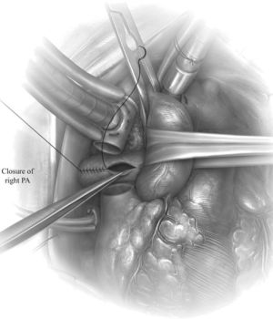 Thromboendarterectomy
