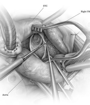 Thromboendarterectomy (Arterial) (3)