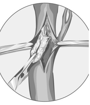 Thromboendarterectomy (Arterial)