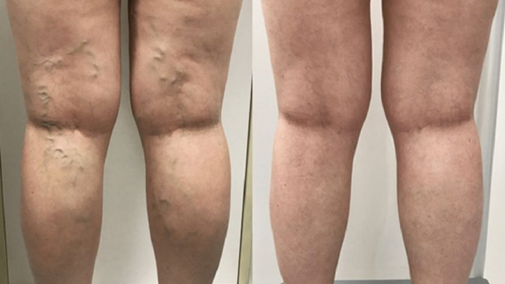 Cosmetic vs Medical Vein Treatment