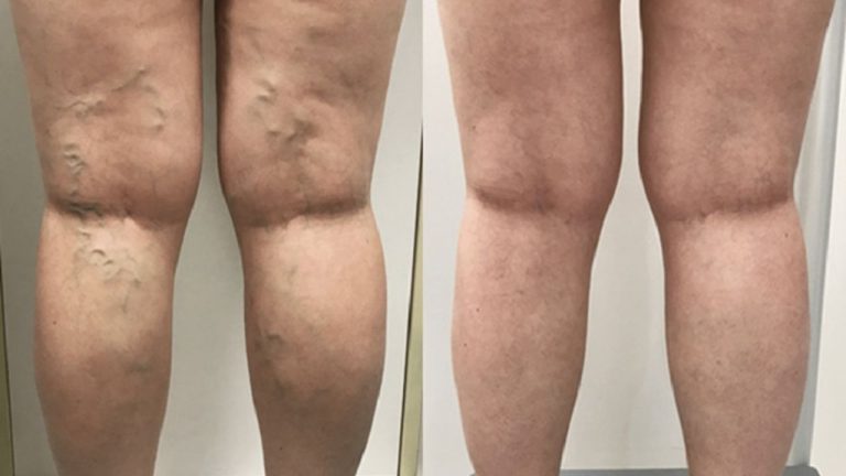 Cosmetic vs Medical Vein Treatment