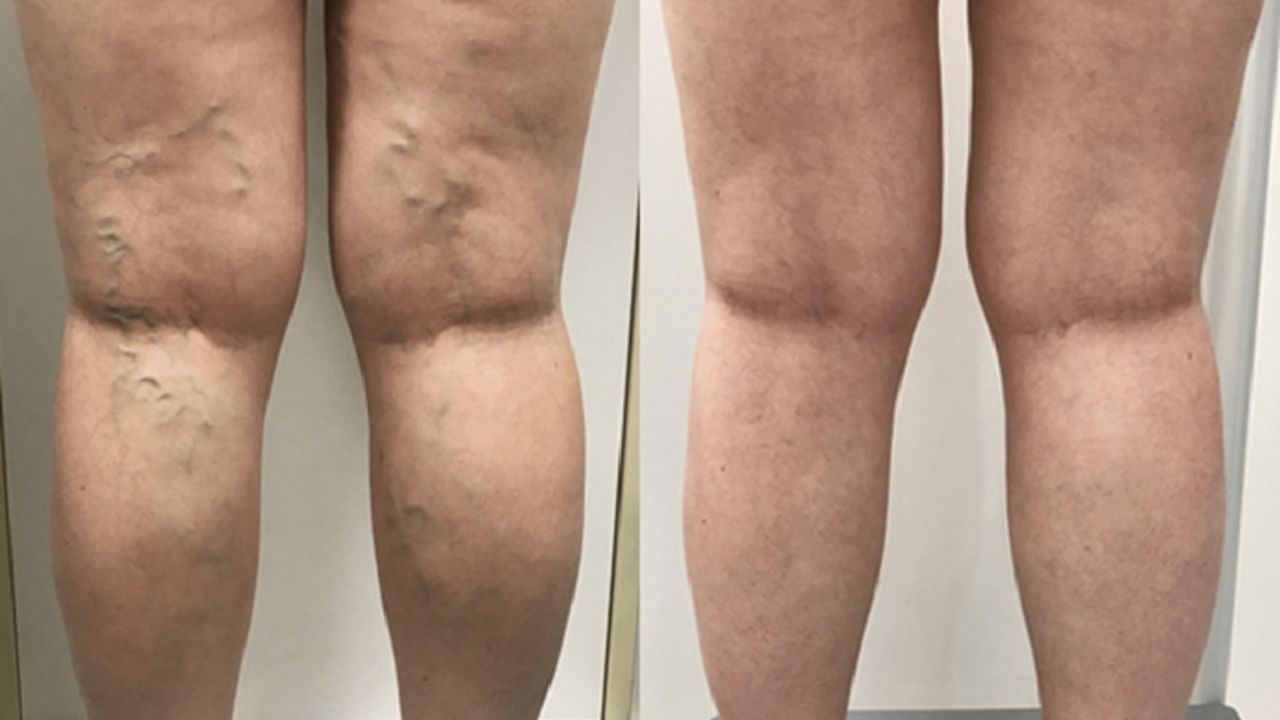 Cosmetic vs Medical Vein Treatment