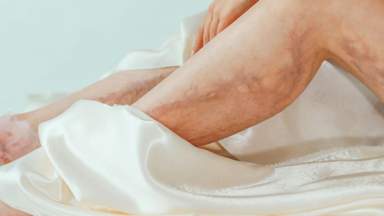 How Much Does Cosmetic Vein Treatment Cost