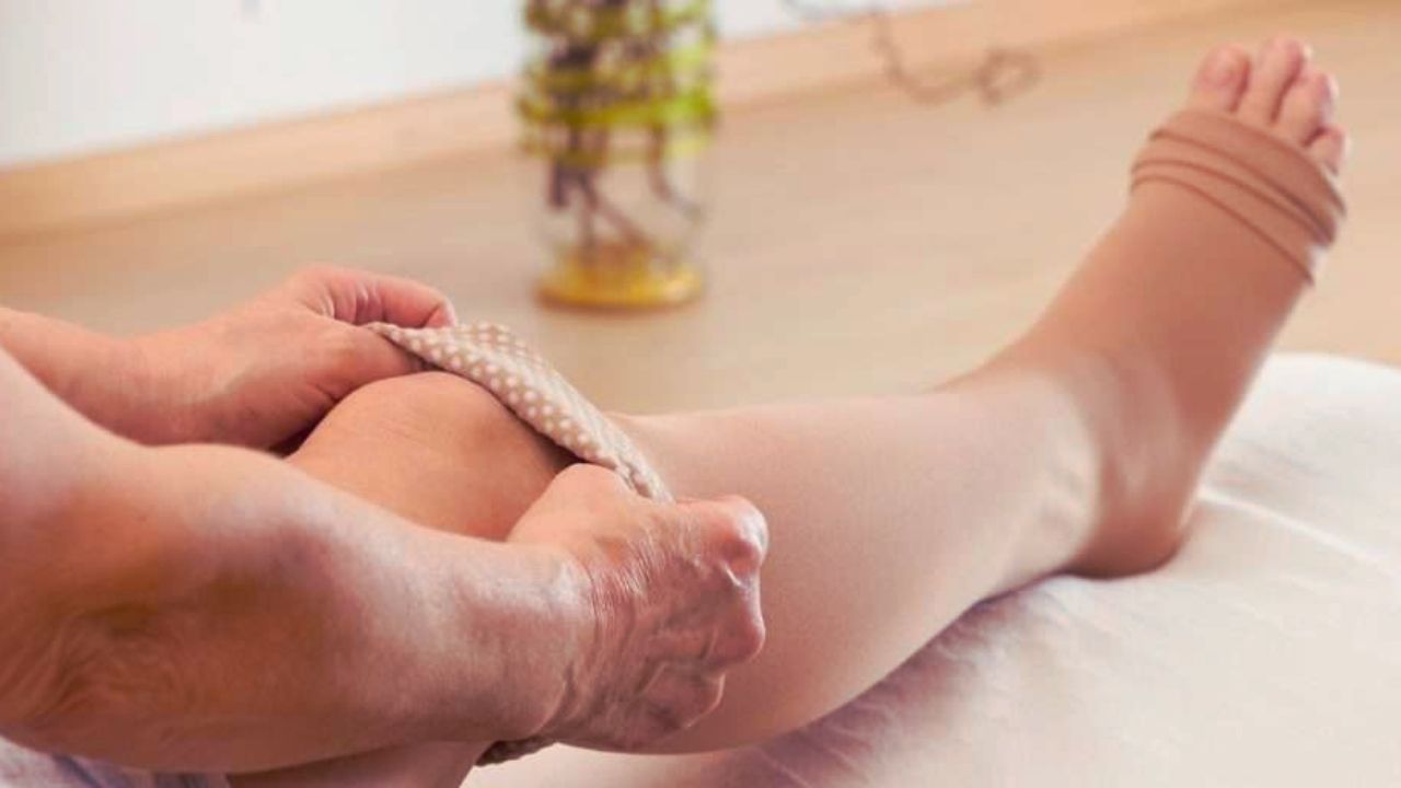 How to Relieve Varicose Vein Pain