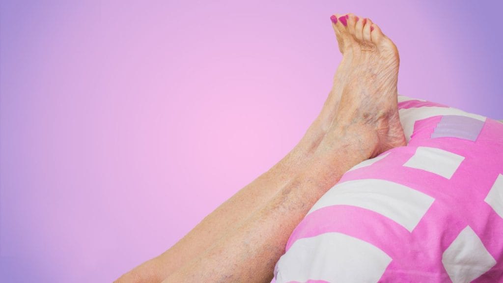 Can Varicose Vein Treatment Cause a Blood Clot