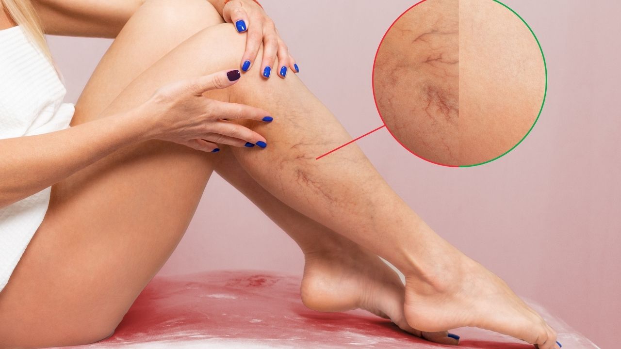 Can Varicose Veins Come Back After Treatment