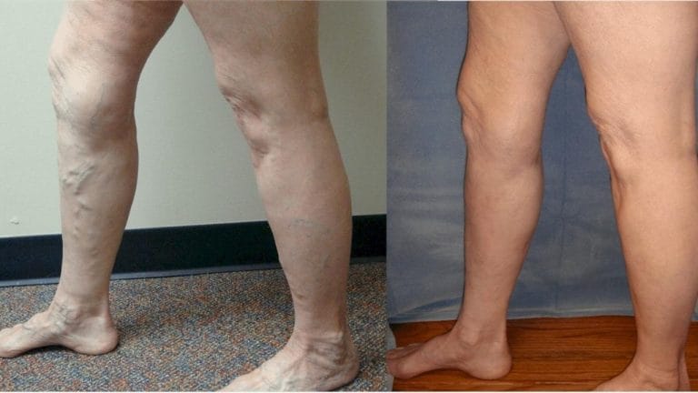 Do Varicose Veins Come Back After Treatment