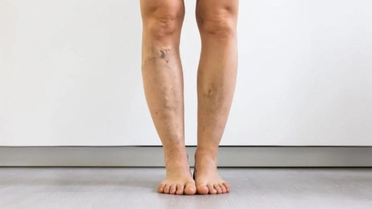 How Much Does Large Leg Varicose Vein Treatment Cost in the U.S