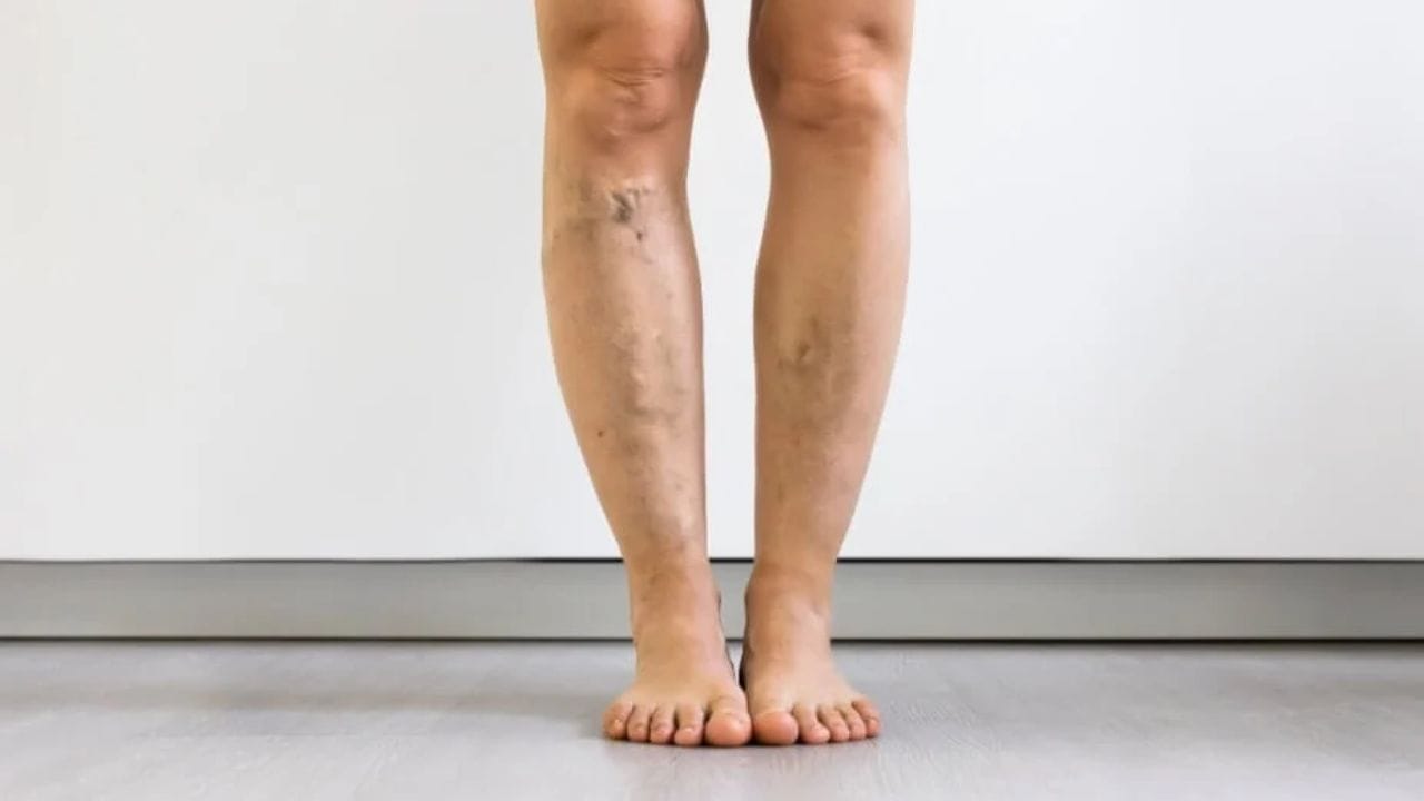 How Much Does Large Leg Varicose Vein Treatment Cost in the U.S