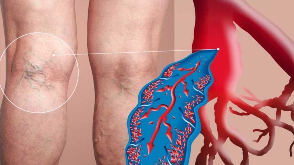 Is Varicose Vein Treatment Painful