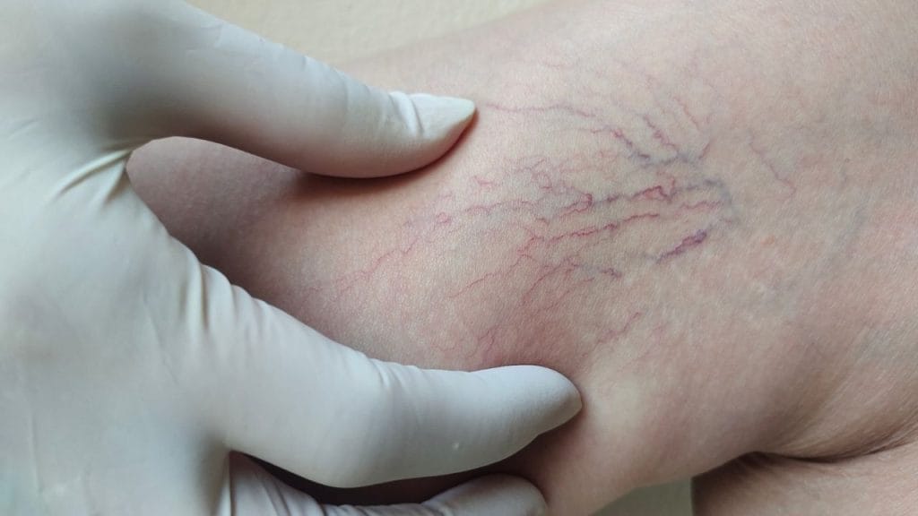 Varicose Veins Treatment Cost