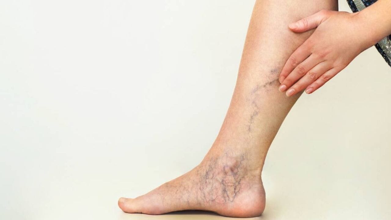 When to Seek Treatment for Varicose Veins