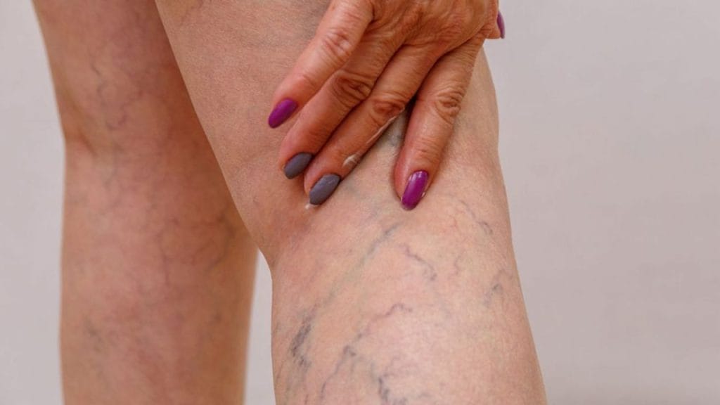 When to Worry About Varicose Veins