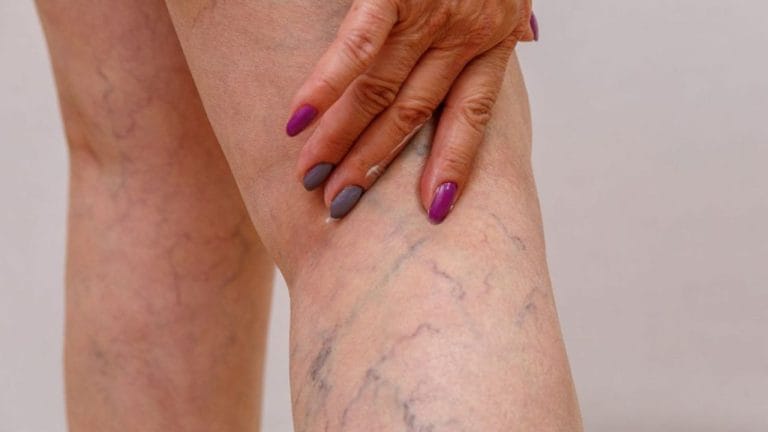When to Worry About Varicose Veins