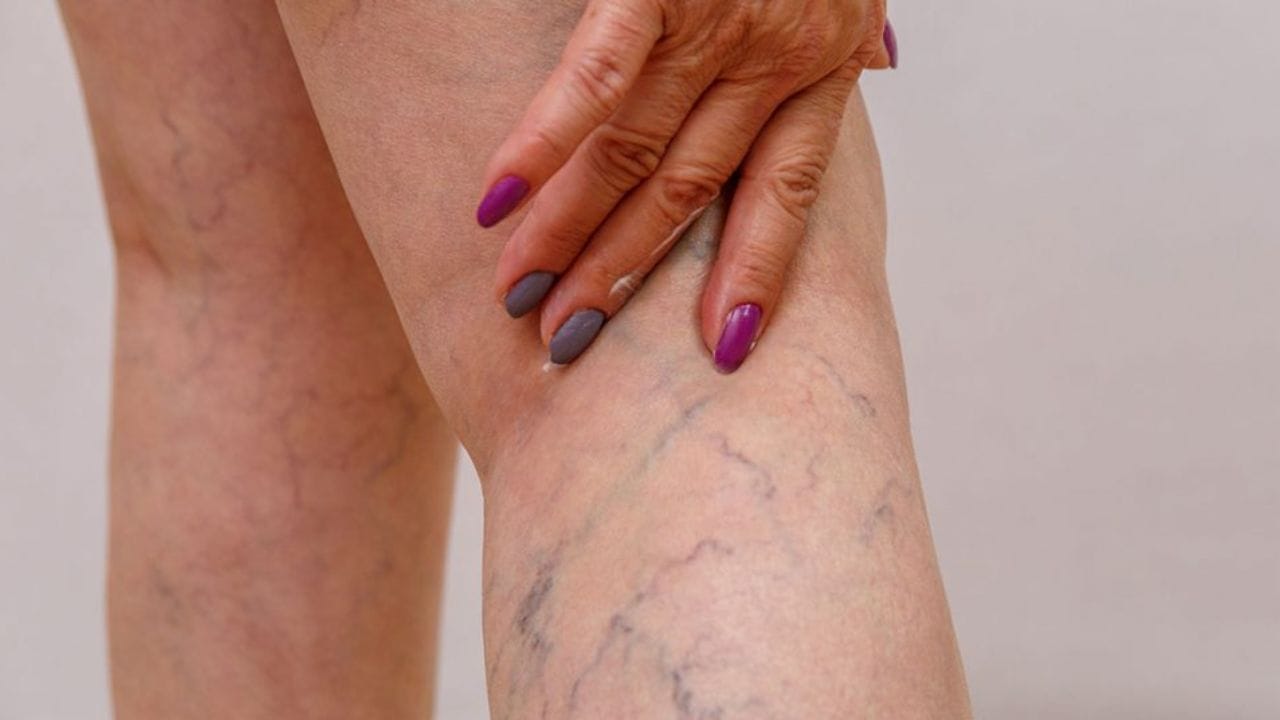 When to Worry About Varicose Veins