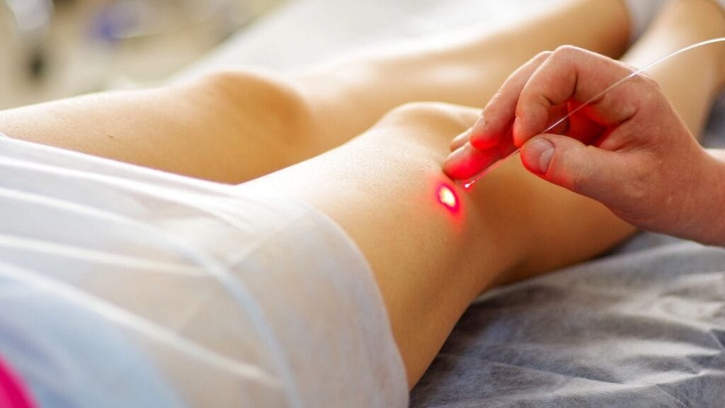 Laser therapy for treating varicose veins
