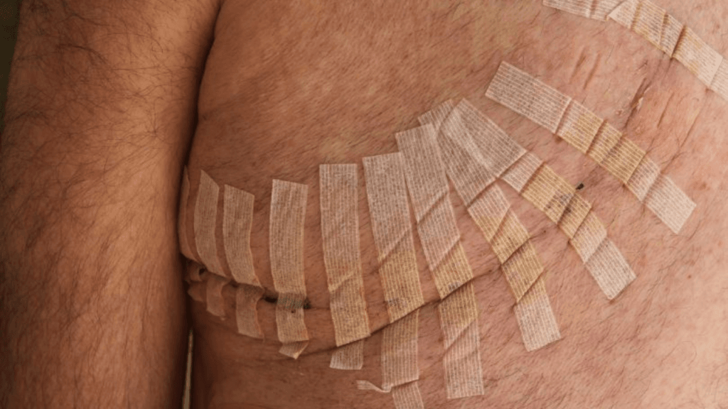 Can You Put Ointment Over Steri-Strips