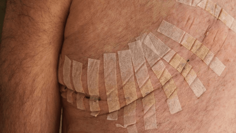 Can You Put Ointment Over Steri-Strips