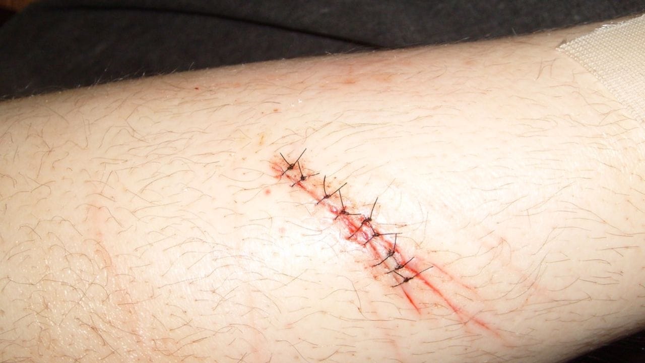 How to Remove Dried Blood from Skin After Surgery