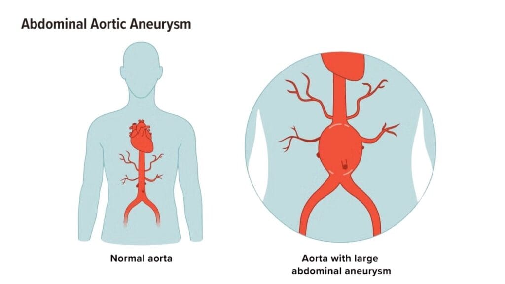 Are Abdominal Aortic Aneurysms Hereditary