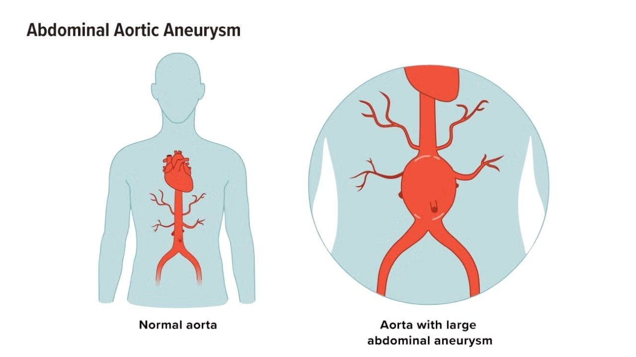 Are Abdominal Aortic Aneurysms Hereditary