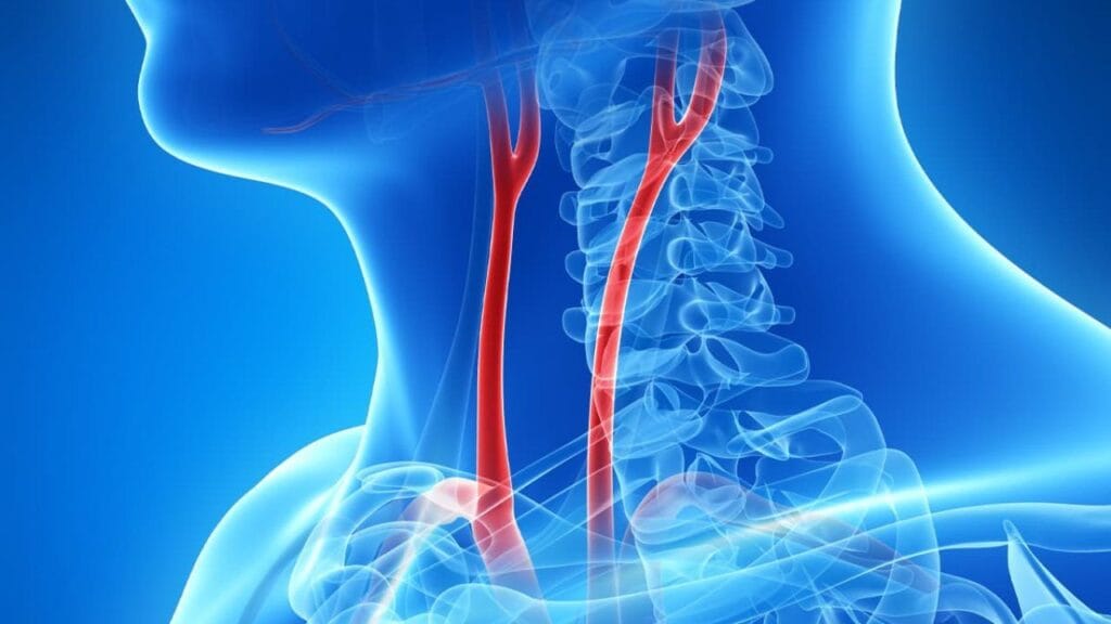 Can Radiation Cause Carotid Stenosis