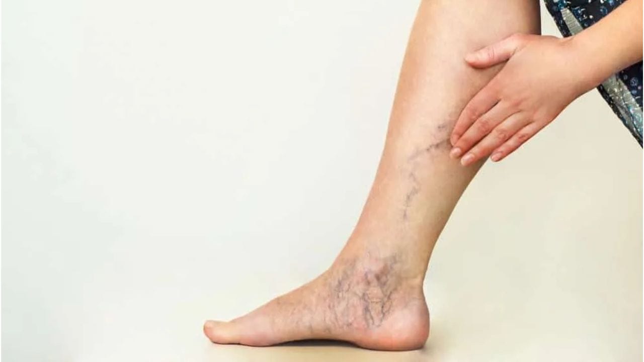 Can You Live a Long Life with Venous Insufficiency