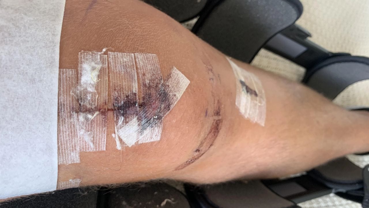 How long should steri strips stay on after surgery