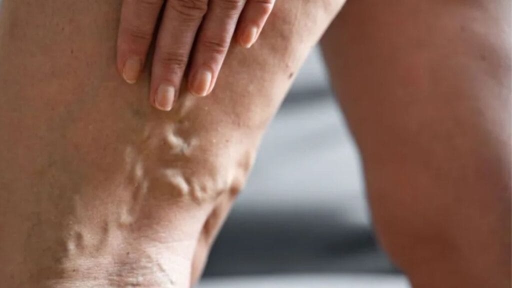 can venous insufficiency be reversed