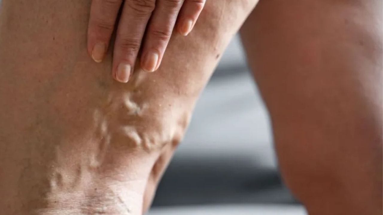 can venous insufficiency be reversed