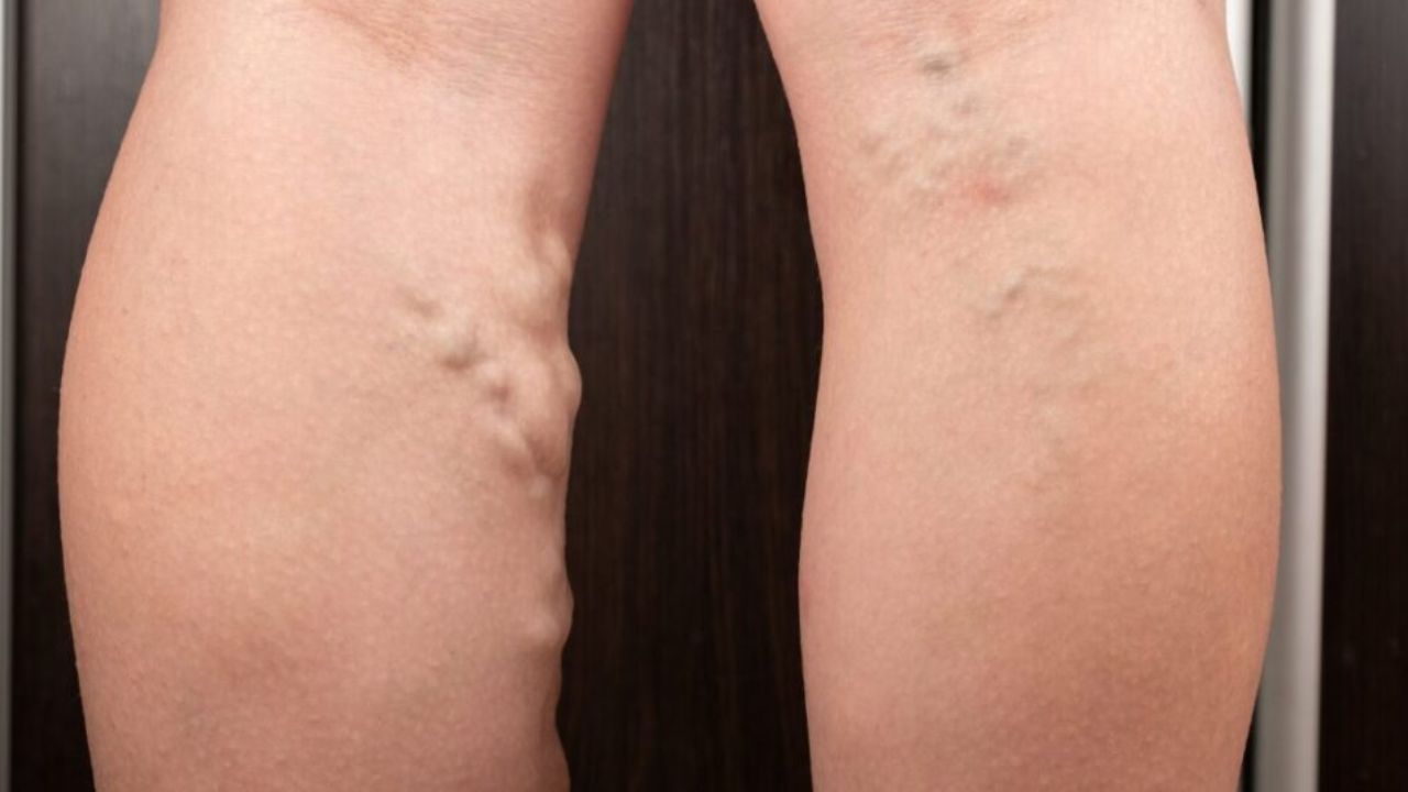 Can Venous Insufficiency Be Prevented