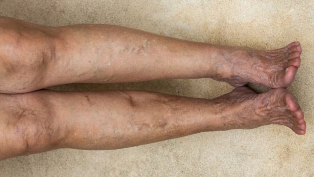 Can You Die From Chronic Venous Insufficiency