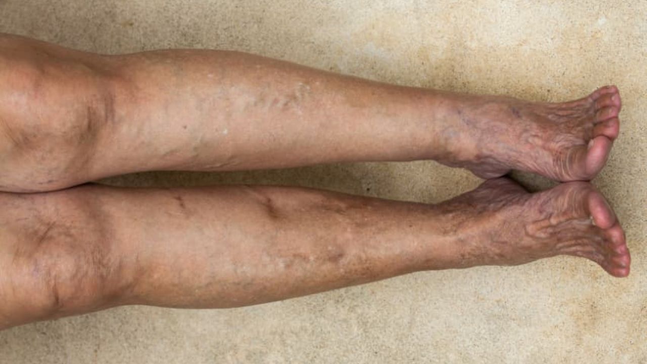 Can You Die From Chronic Venous Insufficiency