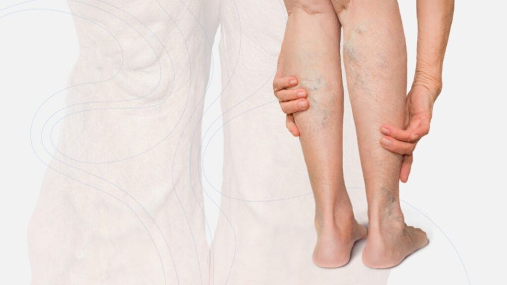 How Dangerous Is Chronic Venous Insufficiency