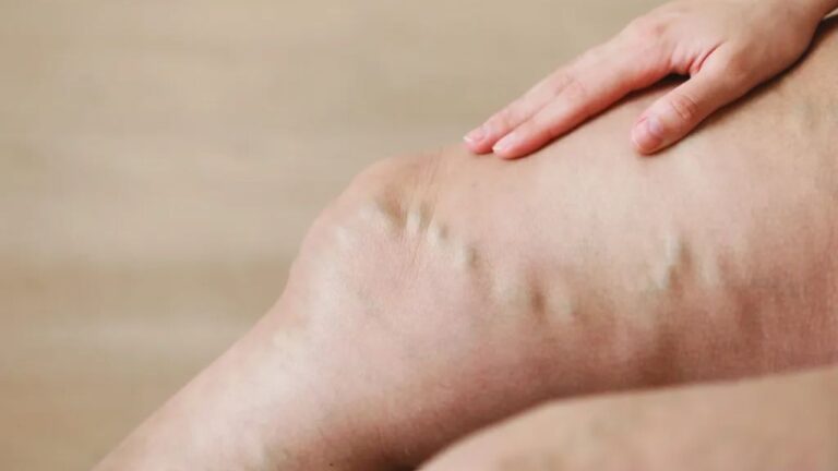 Is Venous Insufficiency Fatal